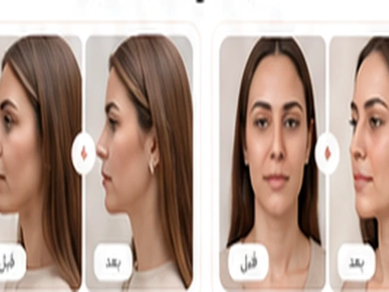 تزریق فیلر و ژل