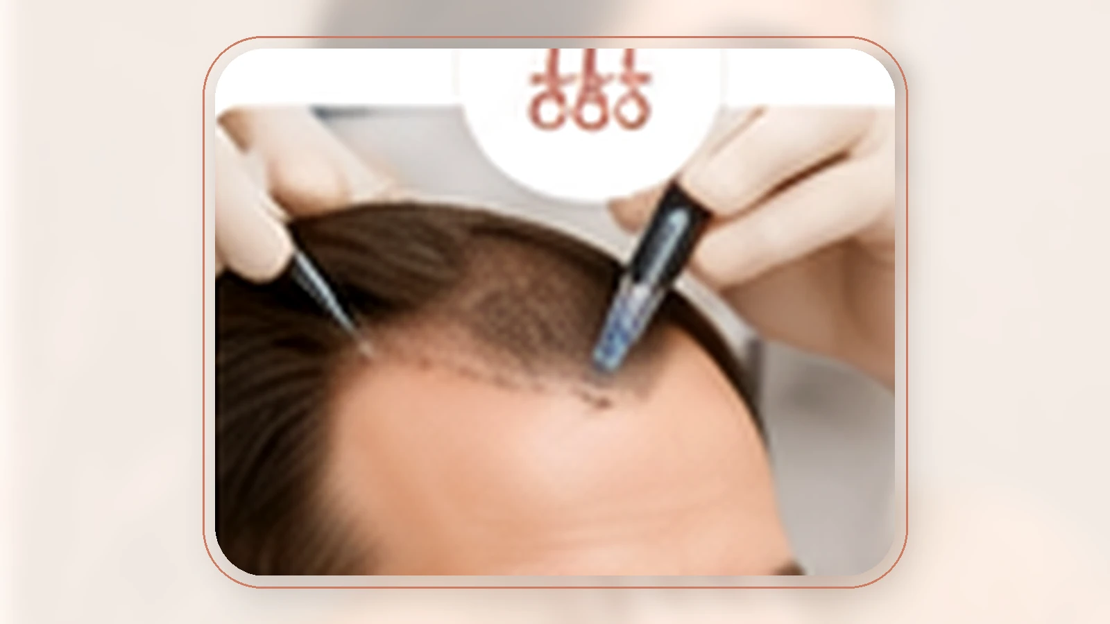 نحوه انجام مزوتراپی مو